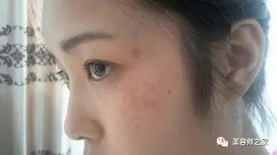 颈椎病10种的最好治疗方法,颈椎病常用的4种治疗方案