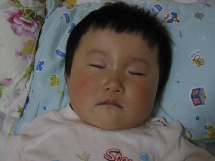 七个半月婴儿急疹症状及护理方法,婴儿急疹需要注意什么事项