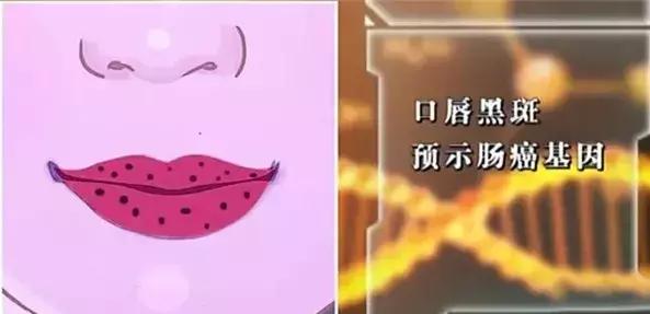 这四种痣会癌变赶紧来了解一下,这5种癌及早发现同样能治愈