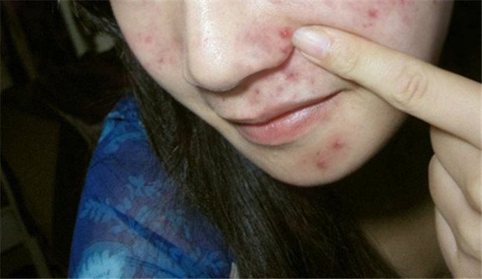 脸上螨虫很多用什么护肤品,脸上螨虫多除螨用什么药物