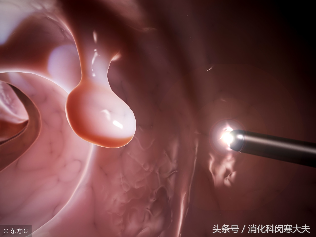 胃息肉和肠息肉哪个更容易复发,肠息肉切了后会复发吗