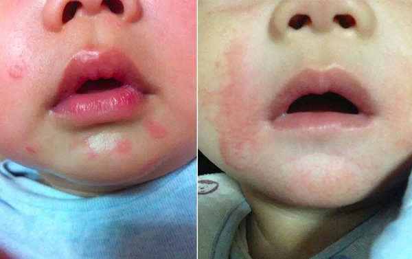 婴儿肌肤总有问题,远离宝宝肌肤问题