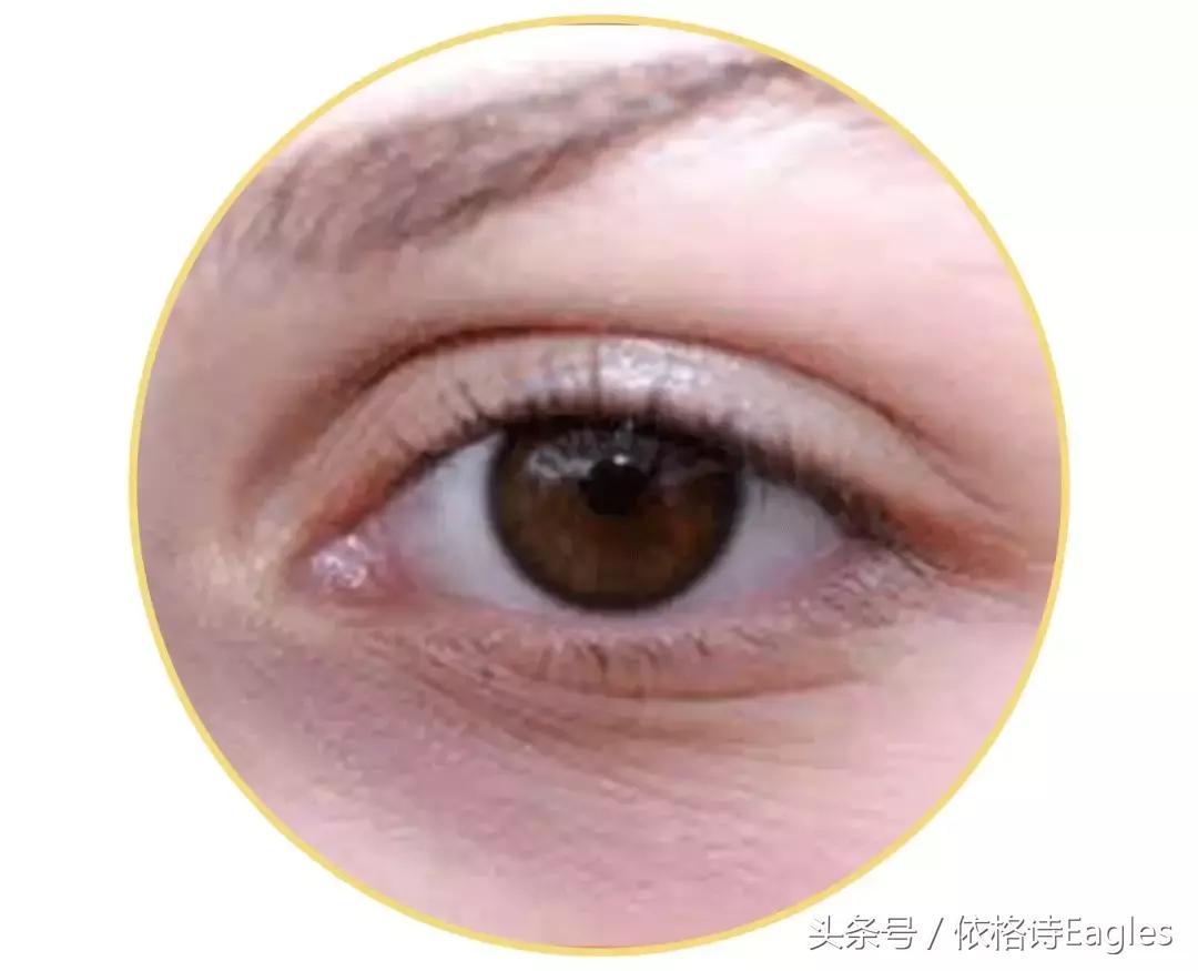 黑眼圈色素沉淀还有救吗,细纹黑眼圈用什么眼霜