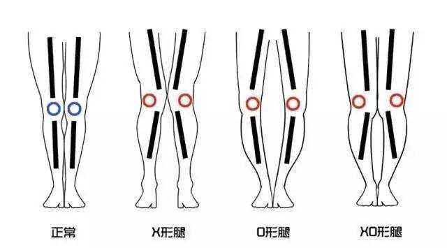 x型腿腿不直怎么办,x型腿o型腿的原因