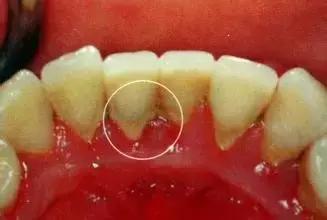 牙周炎最新治疗技术,牙周炎是怎么引起的