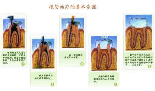 小孩蛀牙影响到牙神经了怎么办,儿童蛀牙疼痛可以杀死牙神经吗