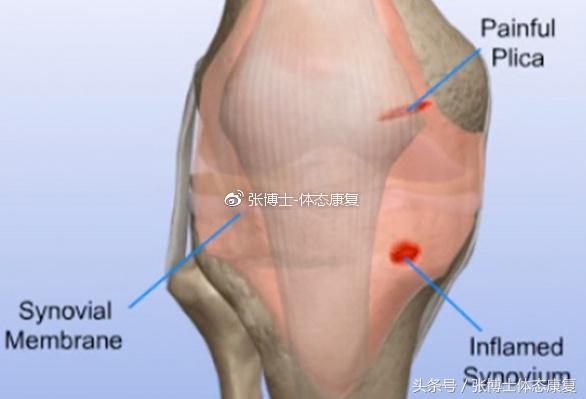 膝关节滑膜皱襞综合征锻炼,膝关节滑膜皱襞综合征怎么治