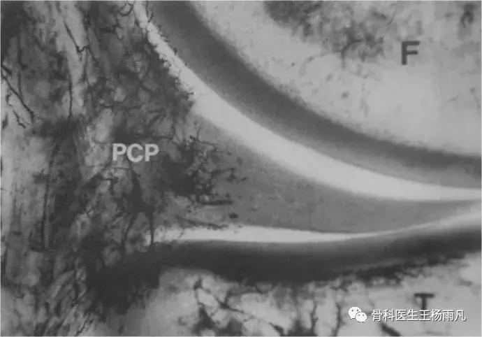 关于半月板的正确说法,半月板前世是什么