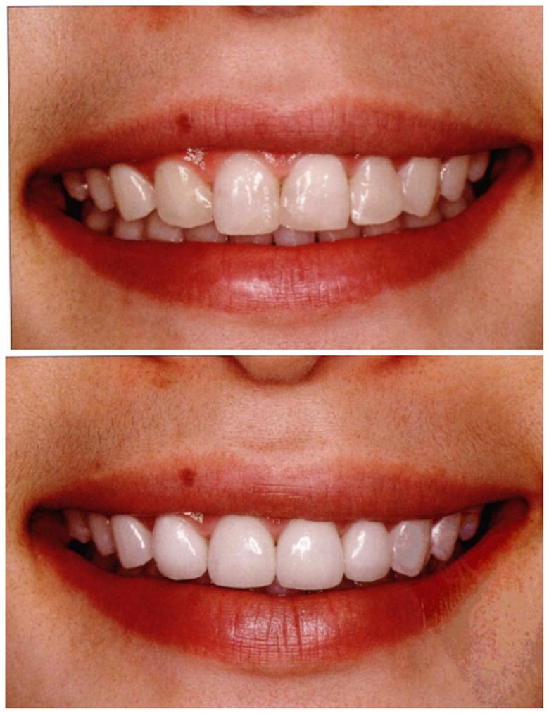 美白牙齿不伤牙齿的方法,牙齿黄不好看怎么美容