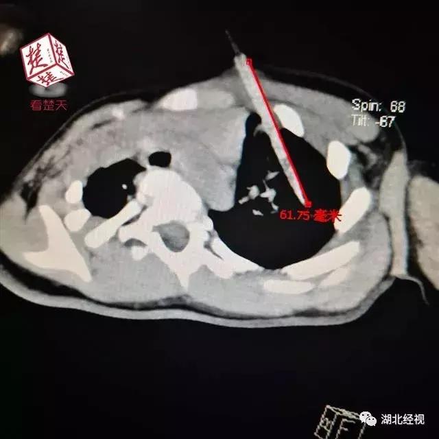 儿童竹签放嘴里危险视频,儿童用竹签戳到喉咙没有出血