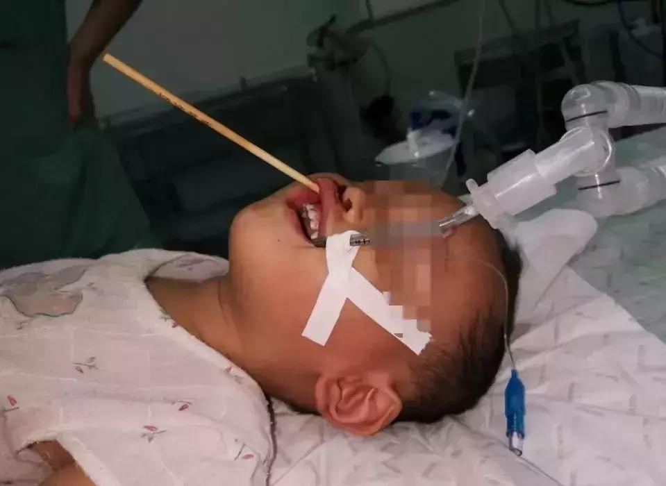 儿童竹签放嘴里危险视频,儿童用竹签戳到喉咙没有出血
