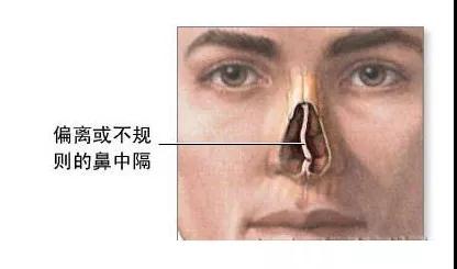 鼻中隔偏曲需要手术治疗吗,鼻中隔偏曲手术引起空鼻症