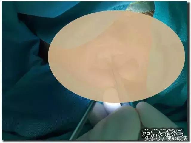 小孩子吃东西被竹签扎到,女童被竹签刺入