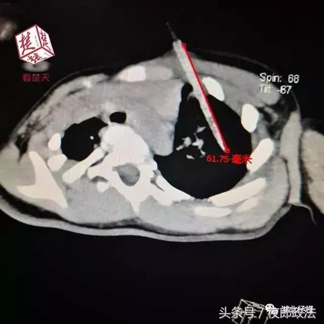 小孩子吃东西被竹签扎到,女童被竹签刺入