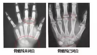 孩子性早熟会长不高!出现这3个特征要当心!