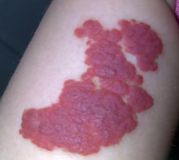 宝宝常见胎记草莓斑,宝宝胎记皮脂腺痣