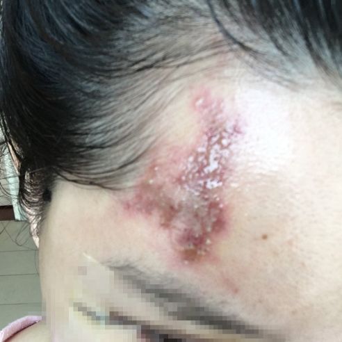 女子整容手术后眼睛失明,南宁一女子整形失败