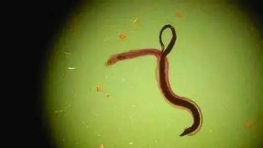 小孩感染肺吸虫,2岁女童吃河蟹肺吸虫