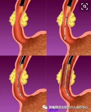 食道癌晚期介入治疗,山西肿瘤医院介入科食管癌