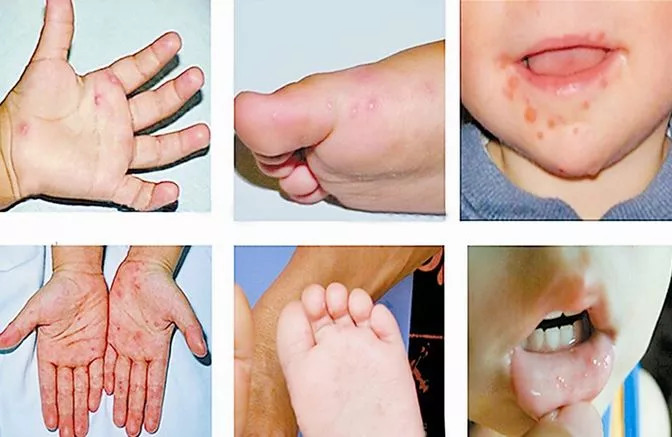 孩子呕吐发烧反反复复,孩子恶心想吐发高烧