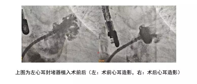 治房颤新技术叫什么,治房颤的应急中成药