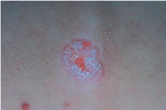 银屑病是什么样的病症,银屑病是免疫系统疾病