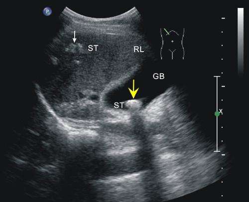 黄疸前期的3个征兆,黄疸的前兆有什么症状和表现