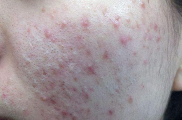 床上螨虫多?需一片叶子,不到1块钱,螨虫有多少死多少