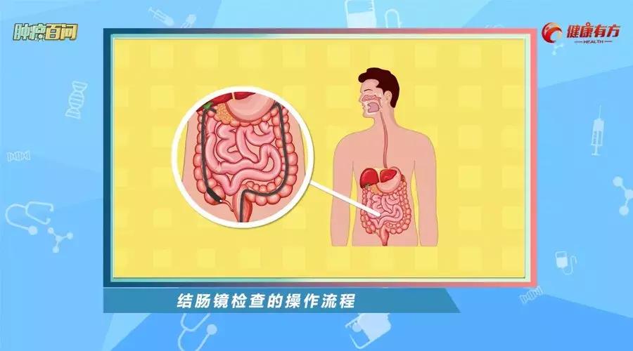 结肠镜检查医保报销吗,肠镜检查和结肠镜区别