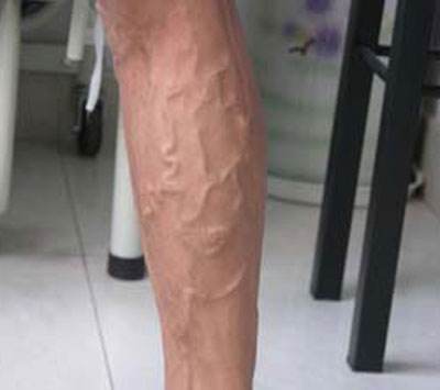 手背脚背青筋暴起是血管堵了吗,手背青筋凸起血管有个米粒小疙瘩