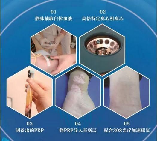 国际上白癜风最新研究成果,国家免费治疗白癜风临床试验