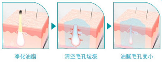 光子嫩肤一次多少钱大概要几次,做光子嫩肤多少钱一次的比较靠谱