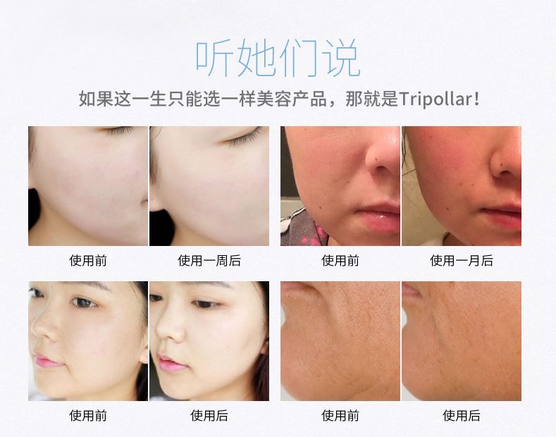童颜机tripollar宙斯,童颜机tripollar溶脂