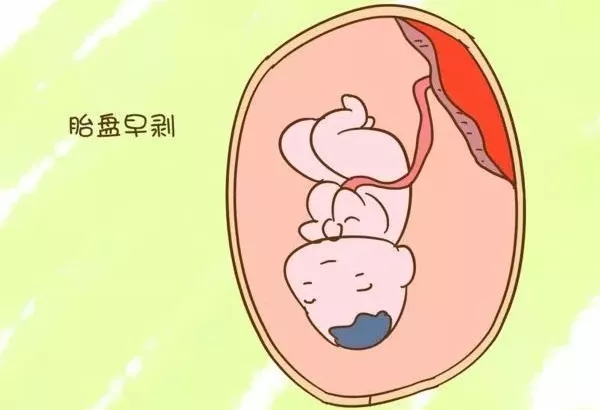 怀孕8个多月胎死腹中的征兆,怀孕八个月胎死腹中是怎么了