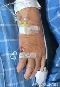 穿刺位置错了怎么处理,穿刺部位应避开什么部位