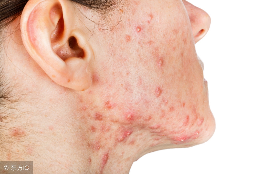 除螨虫最简单方法是什么,螨虫最快最有效的去除方法