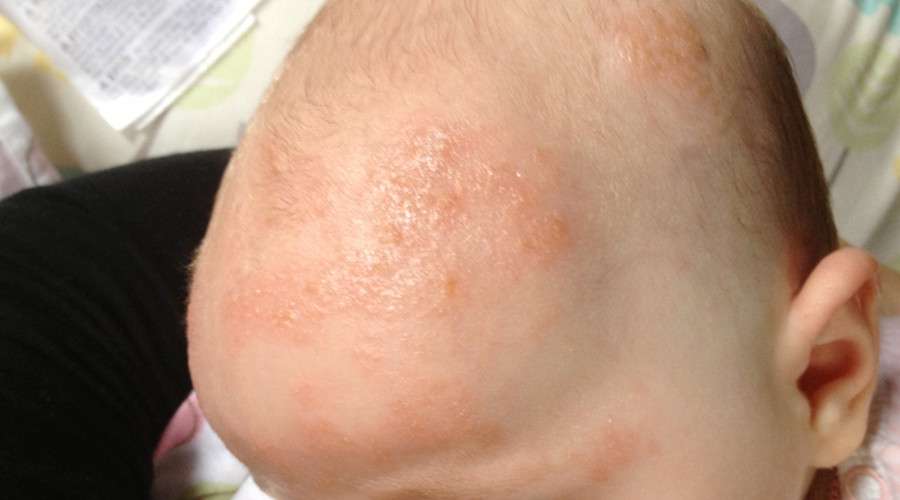 怎么分清痱子还是湿疹,怎么分清是痱子还是湿疹