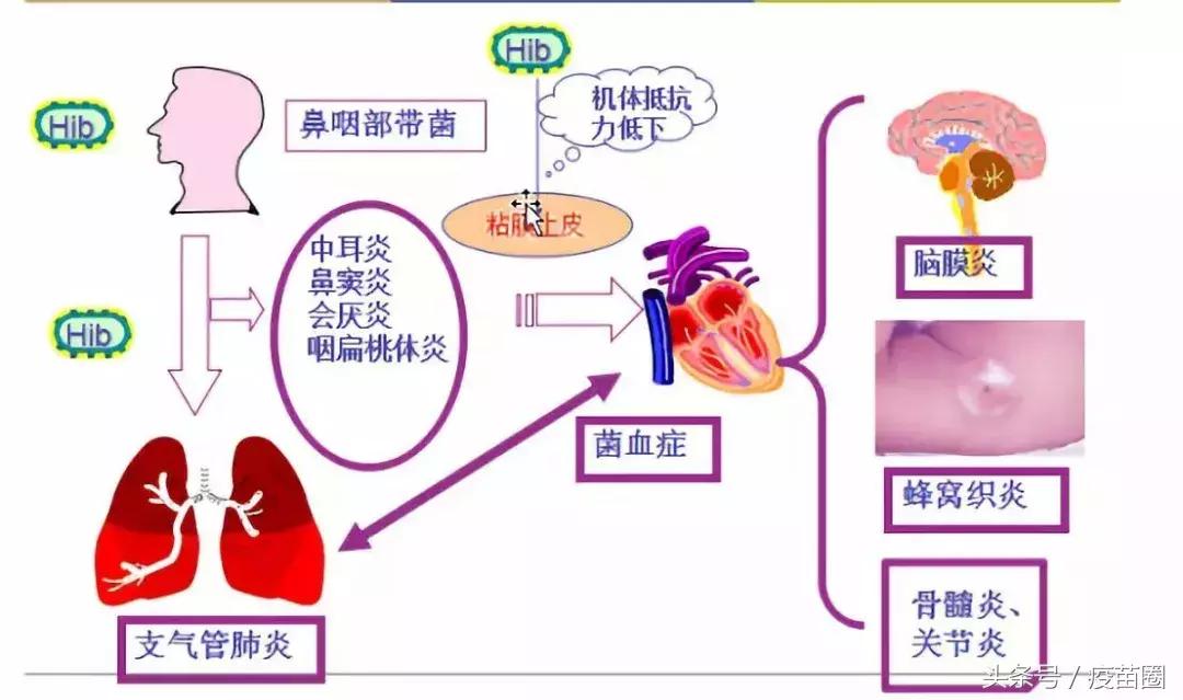 b型流感嗜血杆菌和hib一样吗,hib流感嗜血杆菌预防哪种疾病