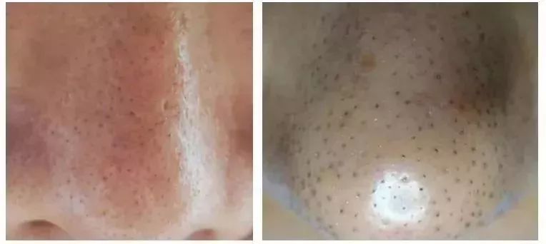 脸上污垢,脸上的脏东西真能清理出来吗