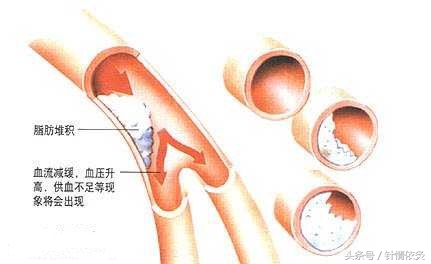 适宜针灸调理的常见病证-针灸调治高脂血症