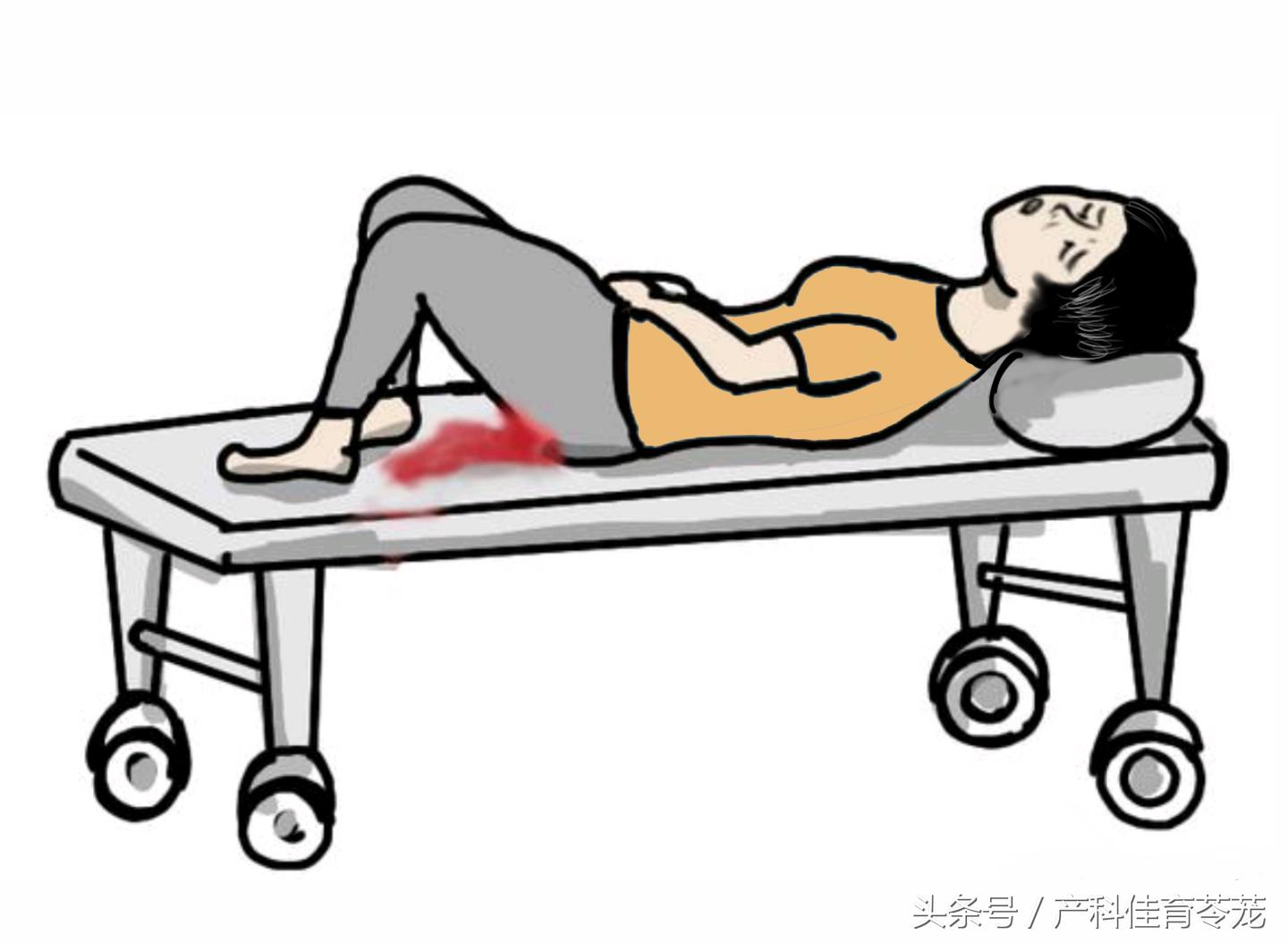 女性出血警惕癌症,绒癌出血能止住吗