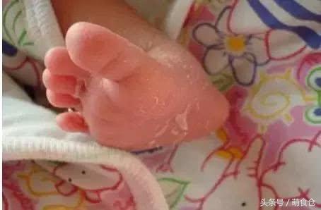 新生儿生殖系统正常生理现象,新生儿有哪些特殊生理现象