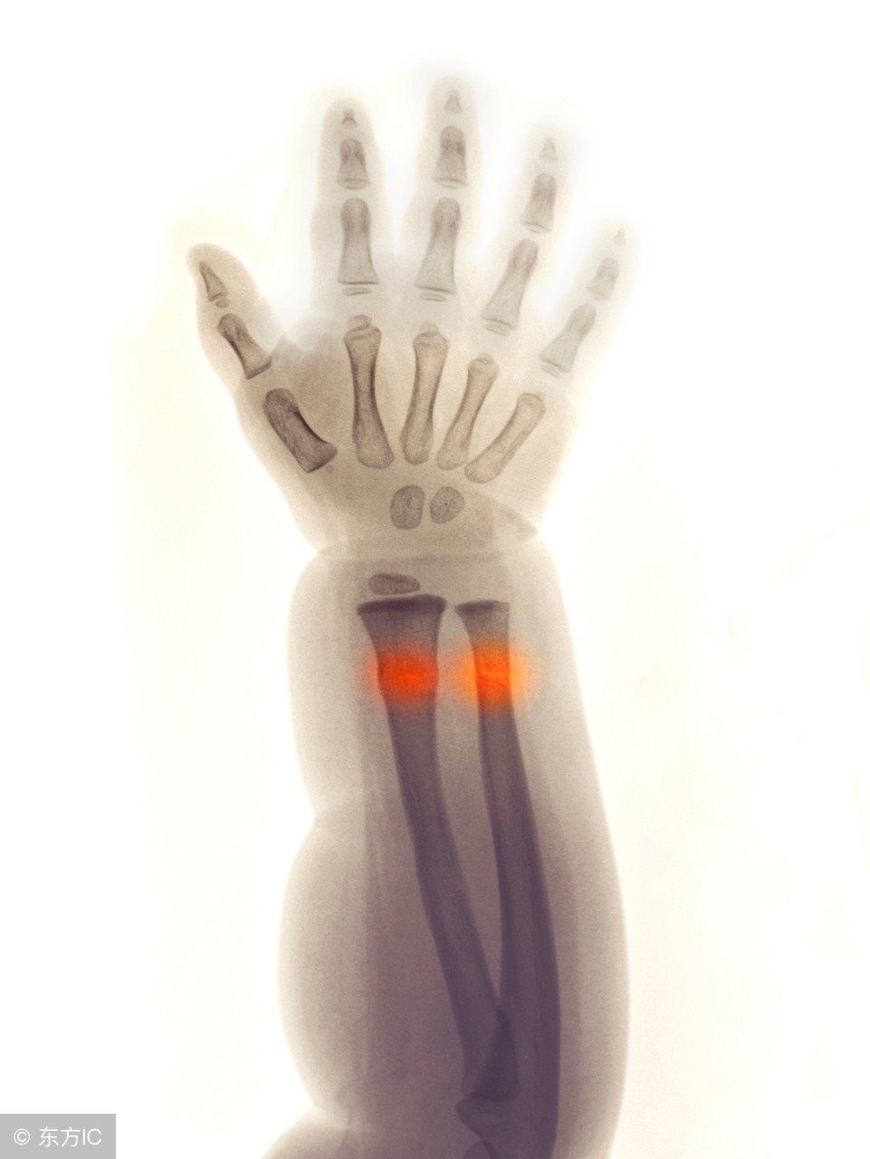 小孩骨折警惕四种表现,小孩骨折需要注意哪些