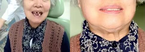 网上缺牙补贴是真的吗,缺牙人士看过来种牙补贴免费领