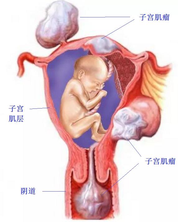 妊娠合并子宫肌瘤，美国医生怎么处理？