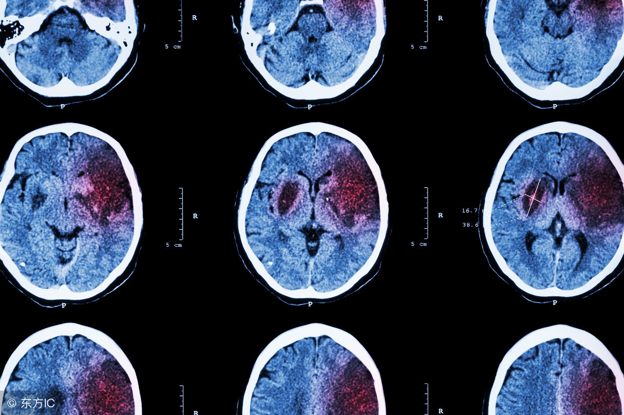 老中医王宝林脑中风急救方法,脑中风急救方法针刺放血有用吗