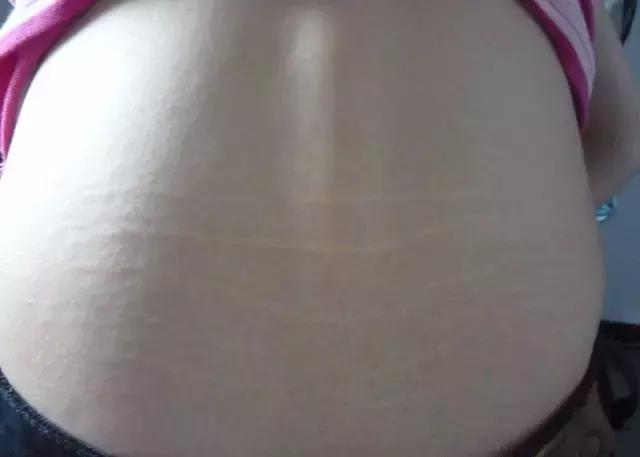 肾虚纹你有吗,肾虚纹腰上