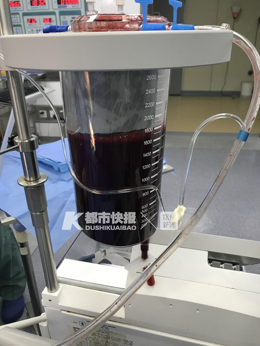 18岁女孩大出血死亡,18岁女孩腹腔出血的原因