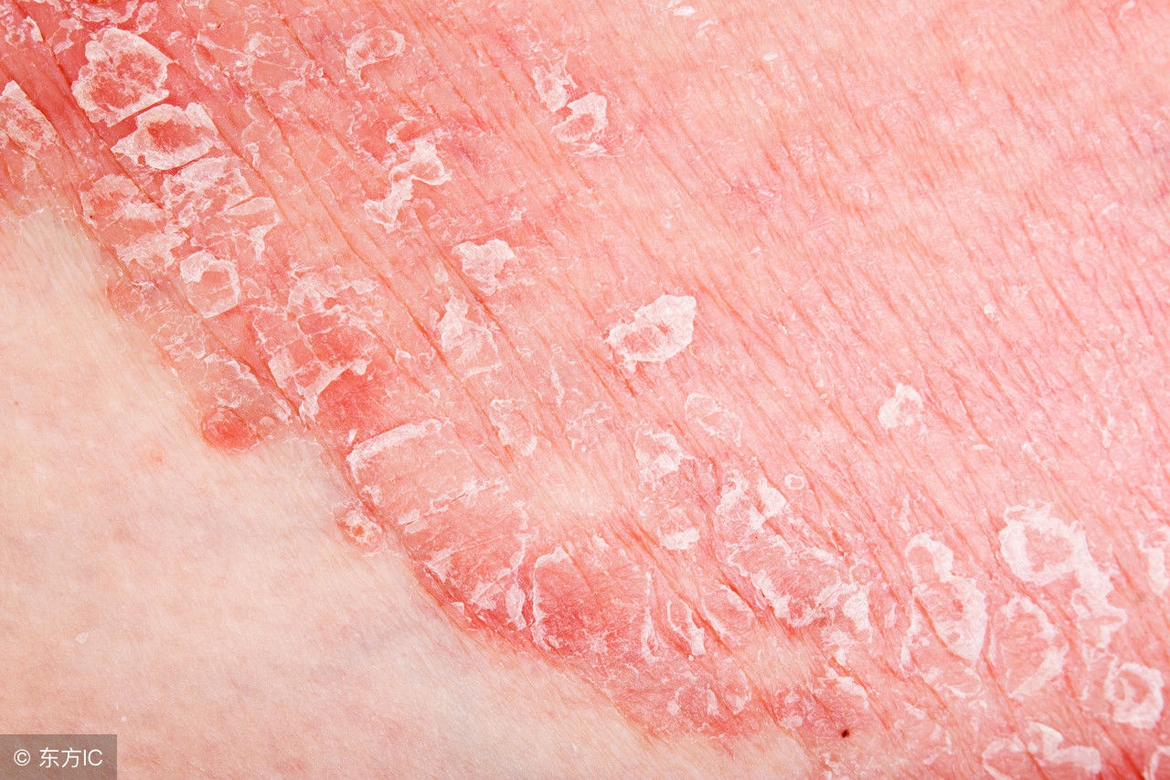 尖锐湿疣在感染的时候具有潜伏期，发病时有何症状