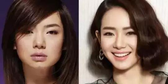 下巴填充和假体植入哪个好,下巴填充膨体跟硅胶哪个更好